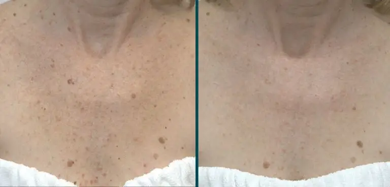 Skin improvements to chest area from BBL Hero Laser Treatment