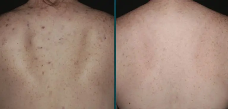 Clear skin results from Forever Clear acne treatment for back