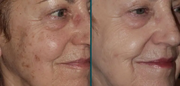 Improvements to skin from Forever Young treatment
