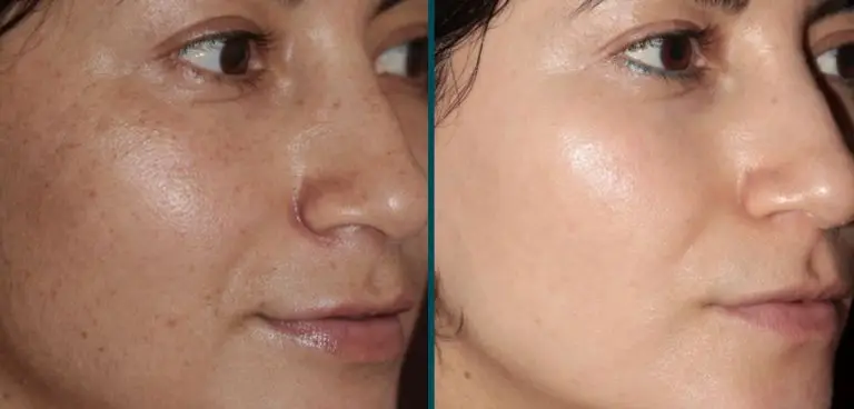 skin improvements from Forever Young treatments