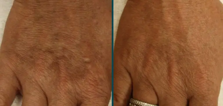 Before & After HALO Treatments