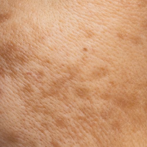 age spots is a treatable condition at NuIQ