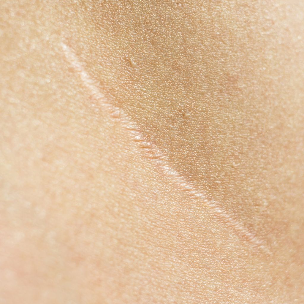 Scars - NUIQ Wellness Lounge and Med Spa