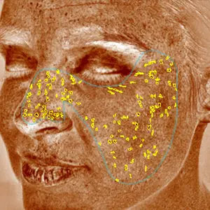 visia skin analysis showing brown spots