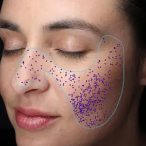 visia skin analysis showing pores