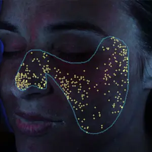 visia skin analysis showing porphyrins