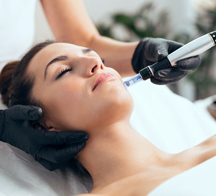 woman getting microneedling facial treatment