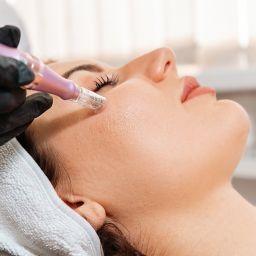 microneedling session at NuIQ med spa in cleveland