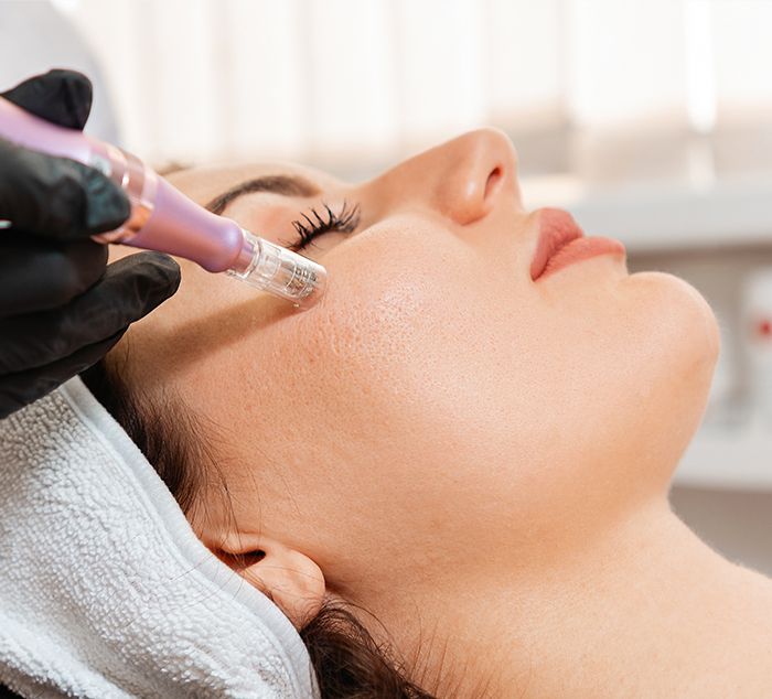 microneedling session at NuIQ med spa in cleveland