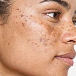 understanding hyperpigmentation and effective treatments in Cleveland